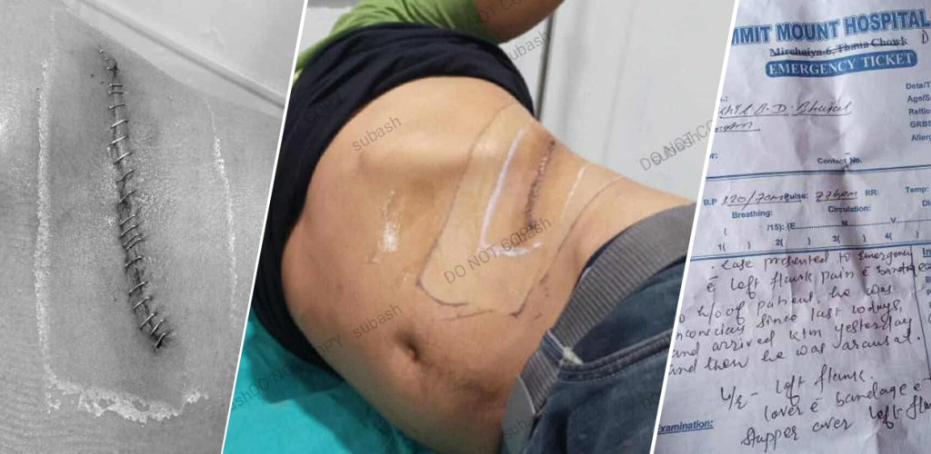 सिन्धुलीका युवकको मिर्गौला निकालिएको घटनामा एकजना पक्राउ